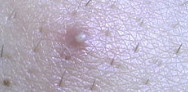 ingrown hair